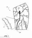 Fig. 02 - Temporary absorbable venous occlusive stent and superficial vein treatment method