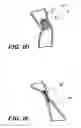 Fig. 05 - Temporary absorbable venous occlusive stent and superficial vein treatment method