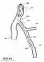 Fig. 07 - Temporary absorbable venous occlusive stent and superficial vein treatment method
