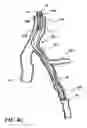 Fig. 09 - Temporary absorbable venous occlusive stent and superficial vein treatment method