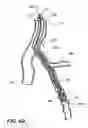 Fig. 10 - Temporary absorbable venous occlusive stent and superficial vein treatment method