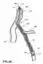 Fig. 11 - Temporary absorbable venous occlusive stent and superficial vein treatment method