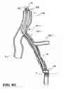 Fig. 13 - Temporary absorbable venous occlusive stent and superficial vein treatment method