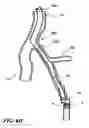 Fig. 14 - Temporary absorbable venous occlusive stent and superficial vein treatment method