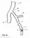 Fig. 15 - Temporary absorbable venous occlusive stent and superficial vein treatment method