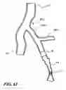 Fig. 16 - Temporary absorbable venous occlusive stent and superficial vein treatment method