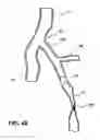 Fig. 17 - Temporary absorbable venous occlusive stent and superficial vein treatment method