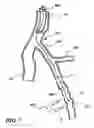 Fig. 18 - Temporary absorbable venous occlusive stent and superficial vein treatment method