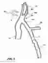 Fig. 19 - Temporary absorbable venous occlusive stent and superficial vein treatment method