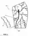 Fig. 02 - Temporary absorbable venous occlusive stent and superficial vein treatment method