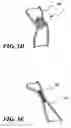 Fig. 05 - Temporary absorbable venous occlusive stent and superficial vein treatment method