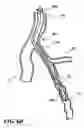 Fig. 08 - Temporary absorbable venous occlusive stent and superficial vein treatment method