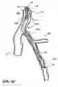 Fig. 09 - Temporary absorbable venous occlusive stent and superficial vein treatment method
