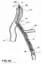 Fig. 11 - Temporary absorbable venous occlusive stent and superficial vein treatment method