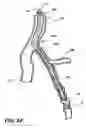 Fig. 12 - Temporary absorbable venous occlusive stent and superficial vein treatment method