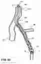 Fig. 13 - Temporary absorbable venous occlusive stent and superficial vein treatment method