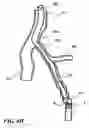 Fig. 14 - Temporary absorbable venous occlusive stent and superficial vein treatment method