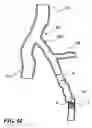 Fig. 15 - Temporary absorbable venous occlusive stent and superficial vein treatment method
