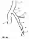 Fig. 16 - Temporary absorbable venous occlusive stent and superficial vein treatment method