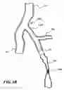 Fig. 17 - Temporary absorbable venous occlusive stent and superficial vein treatment method