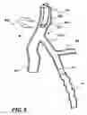 Fig. 19 - Temporary absorbable venous occlusive stent and superficial vein treatment method