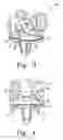 Fig. 03 - Orthopaedic prosthesis having a superparamagnetic material and associated method