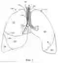 Fig. 02 - Methods and devices for inducing collapse in lung regions fed by collateral pathways