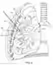 Fig. 10 - Methods and devices for inducing collapse in lung regions fed by collateral pathways
