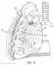Fig. 16 - Methods and devices for inducing collapse in lung regions fed by collateral pathways