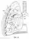 Fig. 19 - Methods and devices for inducing collapse in lung regions fed by collateral pathways