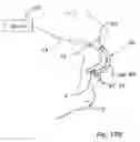 Fig. 12 - Nasal and oral cannula having two capabilities and method of producing same