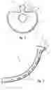 Fig. 03 - Nasopharyngeal airway device and method of use