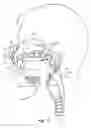 Fig. 04 - Nasopharyngeal airway device and method of use