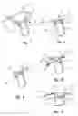 Fig. 07 - Nasopharyngeal airway device and method of use
