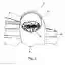 Fig. 03 - Deflection device for a stream body