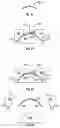 Fig. 14 - Hybrid contact lens system and method