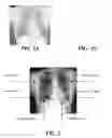 Fig. 02 - Method, apparatus and storage medium for detecting cardio, thoracic and diaphragm borders