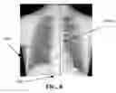 Fig. 09 - Method, apparatus and storage medium for detecting cardio, thoracic and diaphragm borders