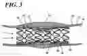 Fig. 03 - Systems for gel-based medical implants