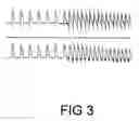 Fig. 04 - Pharmaceutical composition comprising plant material or sp. alone or in association with other plant extracts for the reversion/combat and/or prevention of ventricular fibrillation