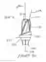 Fig. 19 - Dental restorative system and components