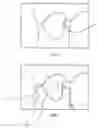 Fig. 02 - Method of preparing dentition for the taking of a dental impression