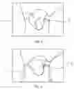Fig. 03 - Method of preparing dentition for the taking of a dental impression