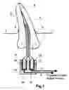Fig. 02 - Method and extractor for removing a tool fragment from a tooth root canal
