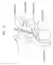 Fig. 19 - Endourethral device & method