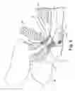 Fig. 03 - Transobturator methods for installing sling to treat incontinence, and related devices