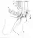 Fig. 04 - Transobturator methods for installing sling to treat incontinence, and related devices