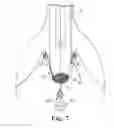 Fig. 07 - Transobturator methods for installing sling to treat incontinence, and related devices