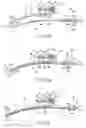 Fig. 12 - Endoscope accessory, endoscope system and method for mounting endoscope accessory to endoscope