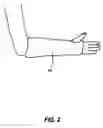Fig. 03 - Protective cast cover